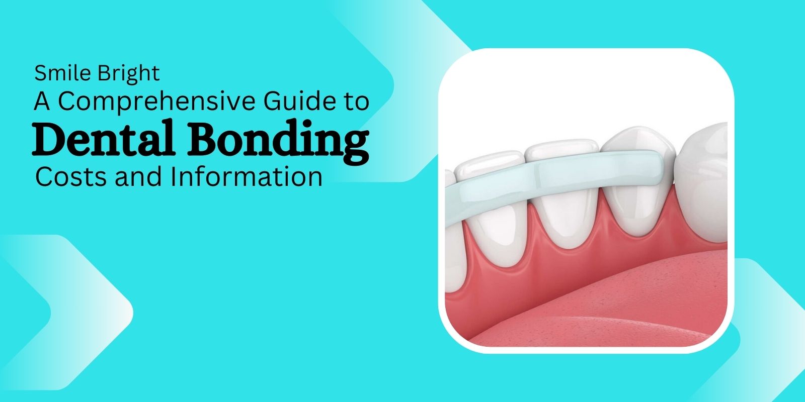Smile Bright: A Comprehensive Guide to Dental Bonding Costs and Information
